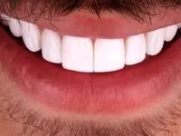 بهترین روش برای جلوگیری از پوسیدگی دندان‌ها