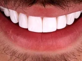 بهترین روش برای جلوگیری از پوسیدگی دندان‌ها