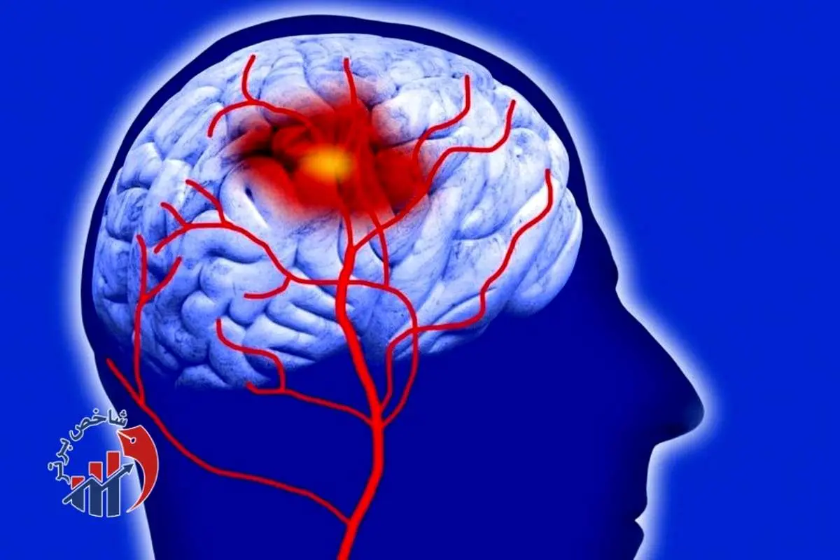 آمار شگفتانگیز از تعداد روزانه سکته مغزی در تهران!