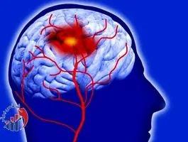 آمار شگفت‌انگیز از تعداد روزانه سکته مغزی در تهران!