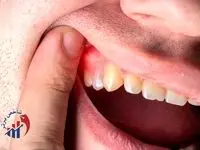 برای سلامت لثه، این خوراکیها را استفاده کنید