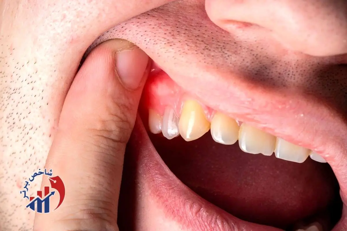 برای سلامت لثه، این خوراکی‌ها را استفاده کنید