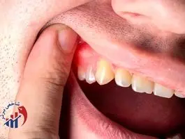 برای سلامت لثه، این خوراکی‌ها را استفاده کنید