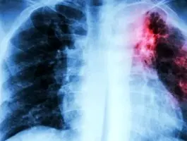 کشنده‌ترین بیماری عفونی جهان معرفی شد